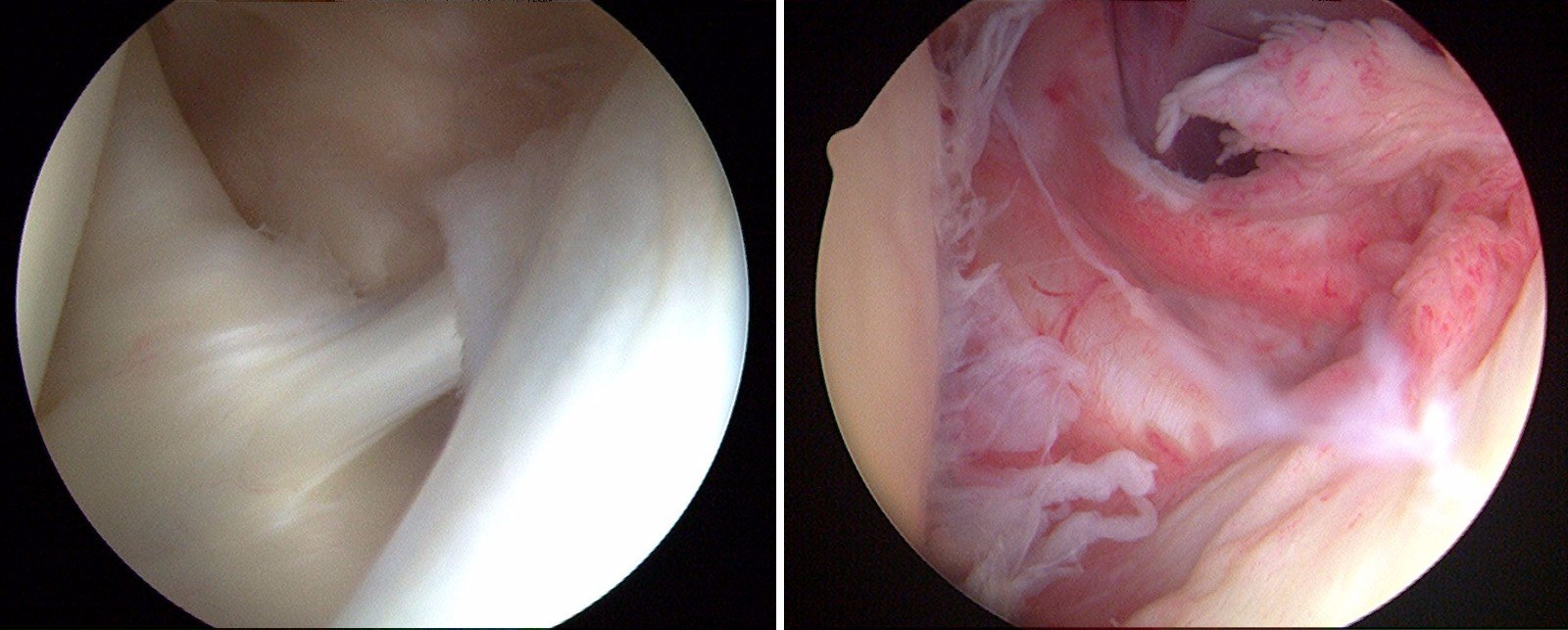 compr_normal-synovium--frozen-shoulder-kh.jpg