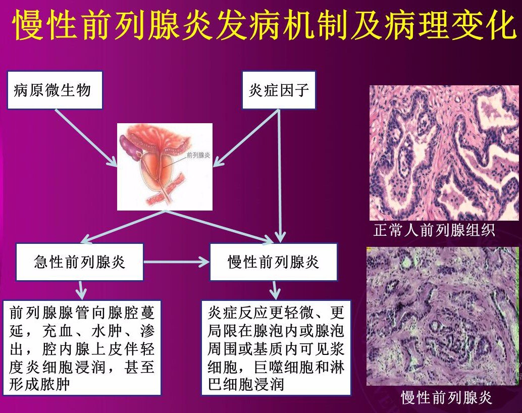 <!--HAODF:8:qianliexianyan--/><!--HAODF:8:qianliexianyan--><!--HAODF:8:qianliexianyan-->前列腺炎<!--HAODF:/8:qianliexianyan--><!--HAODF:/8:qianliexianyan--><!--HAODF:/8:qianliexianyan-->1.jpg
